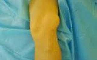 Подвывих бедра код мкб