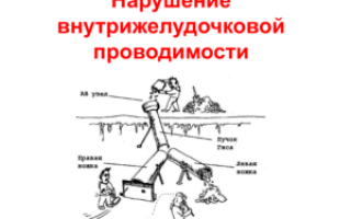 Нарушение внутрижелудочковой проводимости сердца синдром