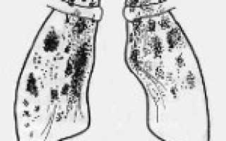 Диссеминация неясной этиологии код по мкб