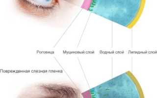 Синдром сухого глаза лечение гели
