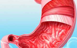 Обострение язвенной болезни код мкб