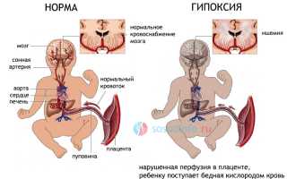 Гипоксическое поражение цнс синдром тонусных нарушений