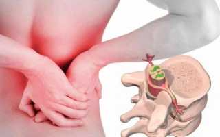 При корешковом синдроме в поясничном отделе чем лечить