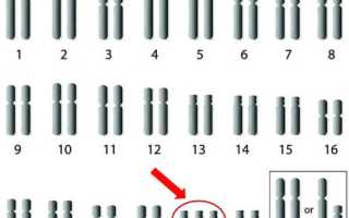 Узи 3 д синдром дауна