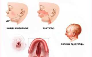 Как кормить детей с синдромом пьера робена