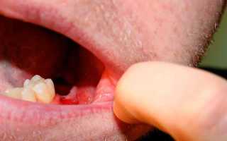 Синдром сухой лунки что это