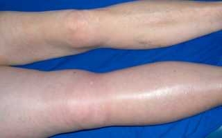 Синдром труссо мигрирующий тромбоз периферических вен фото