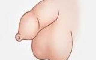 Код мкб рубцовый фимоз