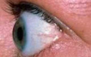 Эндокринный экзофтальм код мкб