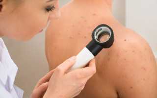 Липома локтевого сустава код по мкб 10