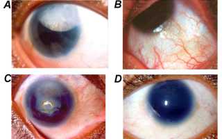 Код по мкб аниридия
