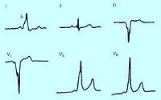 Нарушение ритма сердца синдром впв