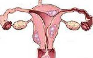 Фибромиома тела матки код по мкб