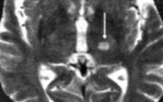 Повторный инфаркт головного мозга мкб 10 код