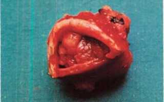 Код диагноза по мкб 033