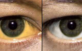 Какие лекарства пьют при синдроме жильбера