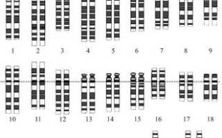 Какой синдром обусловлен наличием трех хромосом 21 пары