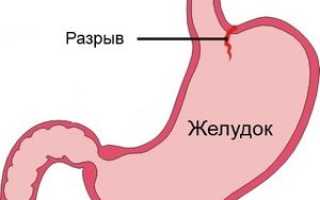 Отрыв пищевода от желудка синдром