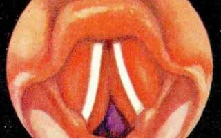 Ложный круп код мкб