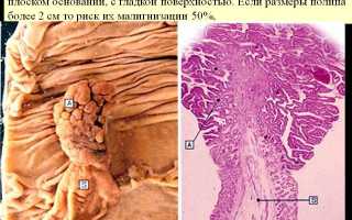 Аденома сигмовидной кишки код мкб