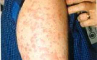 Код мкб при болезни стилла