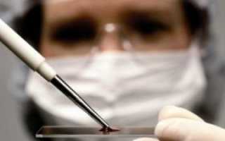 Как лечить синдром поликистоза яичников