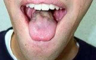 Бульбарный синдром код мкб 10