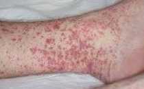 Криоглобулинемический васкулит код мкб