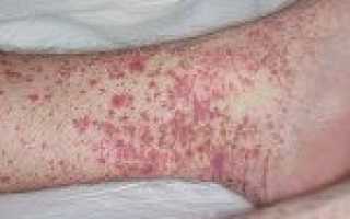 Криоглобулинемический васкулит код мкб