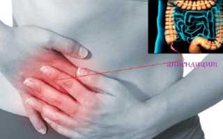 При аппендиците синдром щеткина блюмберга