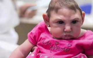 Синдром 18 радиальной кольцевидной хромосомы что это