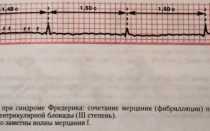 Синдром фредерика в мкб 10