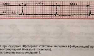 Синдром фредерика в мкб 10