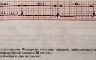 Синдром фредерика в мкб 10