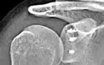 Повреждение акс код по мкб 10