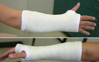 Синдром зудека после перелома лучевой кости