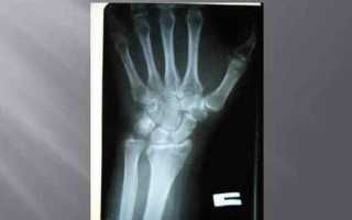 Перелом шиловидного отростка код мкб