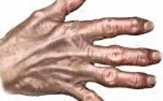 Деформирующий остеоартроз код мкб