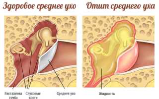 Код мкб 10 мезотимпанит