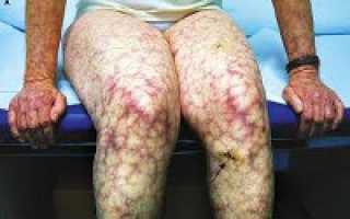 Афс синдром что это такое диагностика