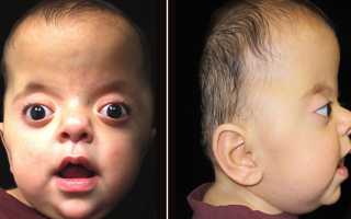 Сколько живут с синдромом апера