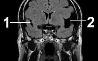 Арахноидальная киста код мкб