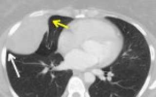 Код мкб объемное образование средостения