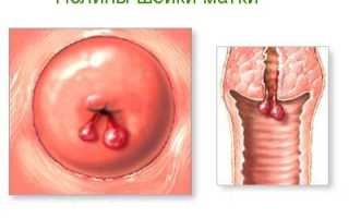 Полип эндоцервикса код мкб