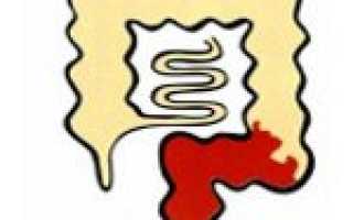 Код мкб 10 проктосигмоидит