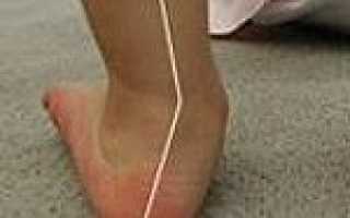 Пвус код мкб 10