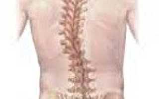 Код сколиоза при мкб