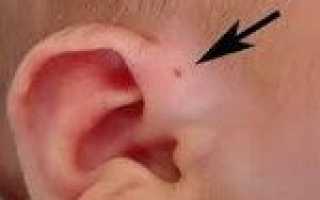 Код мкб свищ шеи