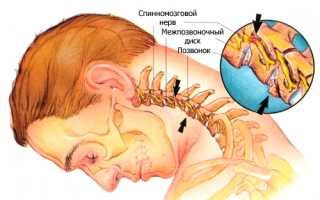 Остеохондроз шейного отдела позвоночника 7 синдромов