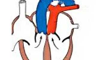 Врожденный порок сердца транспозиция магистральных сосудов код по мкб 10